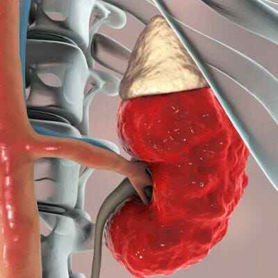 Best Treatment Nephrotic Syndrome
