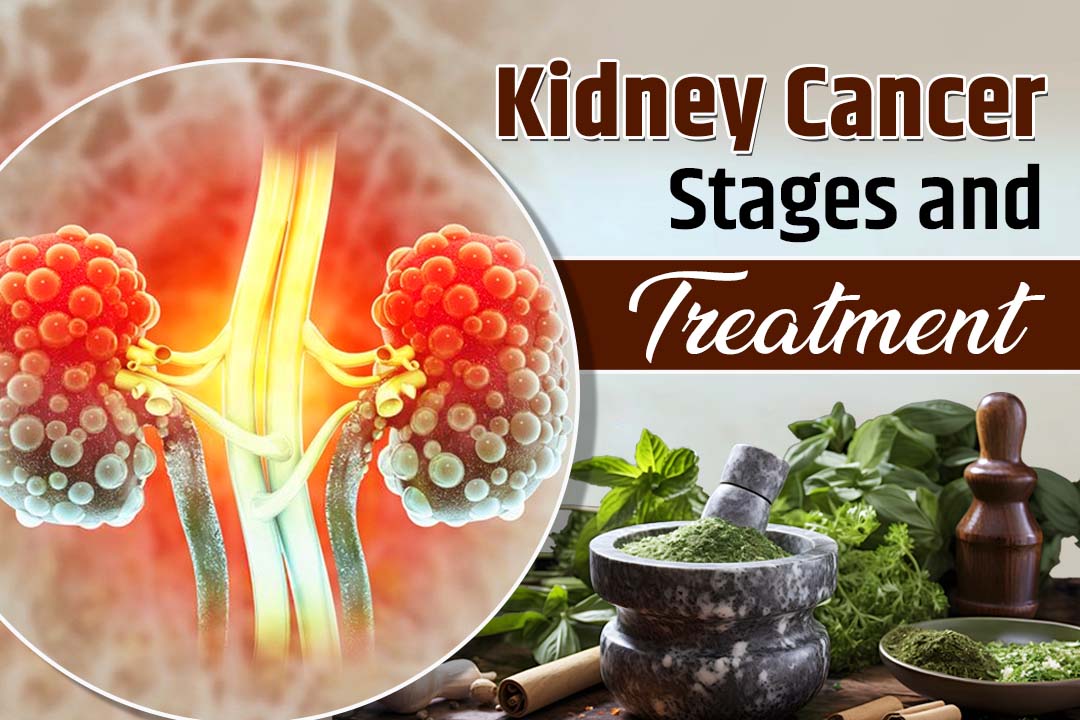 Understanding Kidney Cancer Stages and Treatment