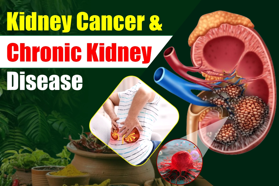Kidney Cancer and Chronic Kidney Disease A Dangerous Duo