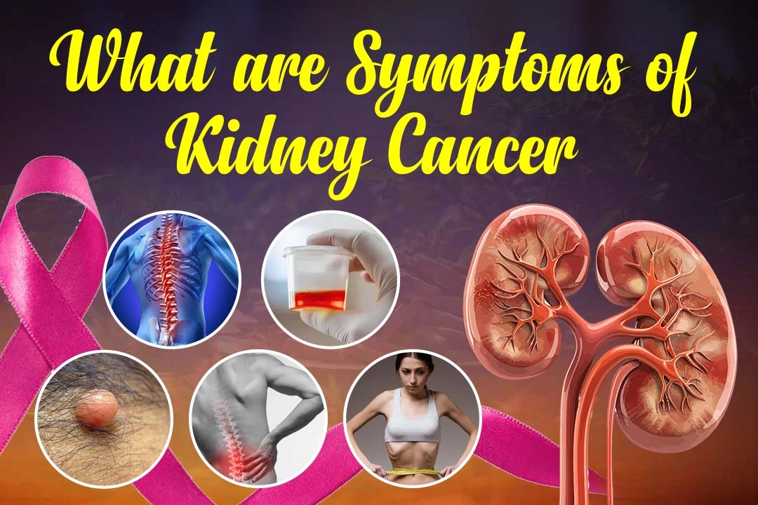 What are Symptoms of Kidney Cancer?