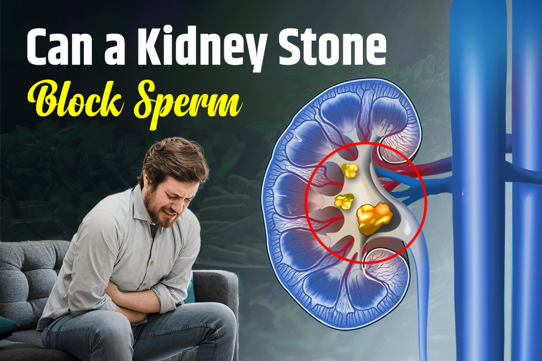 Can a Kidney Stone Block Sperm? Real Facts vs. Myths