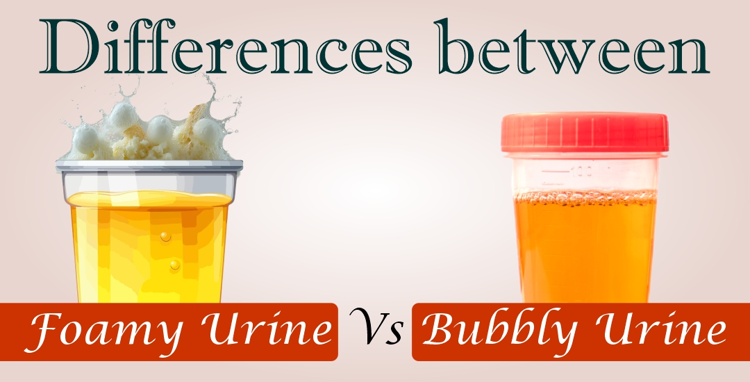 What Is the Difference Between Bubbles and Foam in Urine?